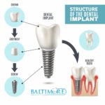 dental-implants-baltimore-md-410-implants
