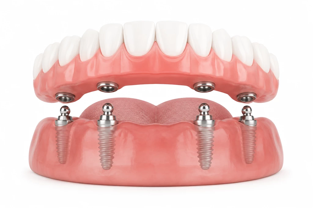 All on 4 dental implants Baltimore Maryland
