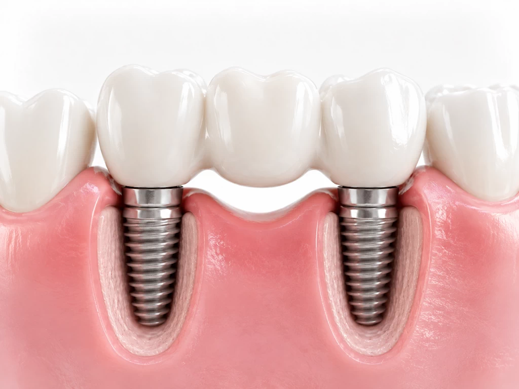 Multiple dental implants Baltimore Maryland