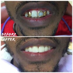 Dental-Impant-before-and-after