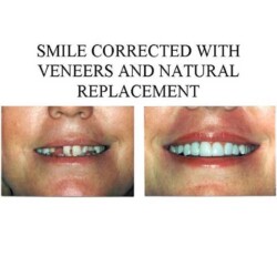 dental-implants-baltimore-glen-burnie-dental-veneers