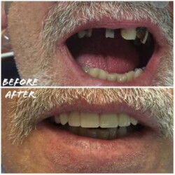 multiple-teeth-Dental-Impant-baltimore-before-and-after