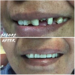 Dental-Impant-before-and-after