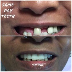 Dental-Impant-before-and-after