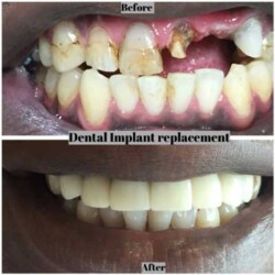 Baltimore-dental-implant-replacement-before-after-photo