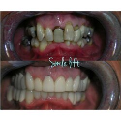 baltimore-dental-implant-smile-lift-dr-hariri